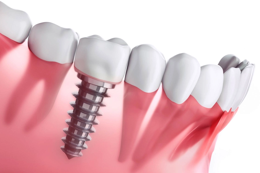 DENTAL IMPLANTS