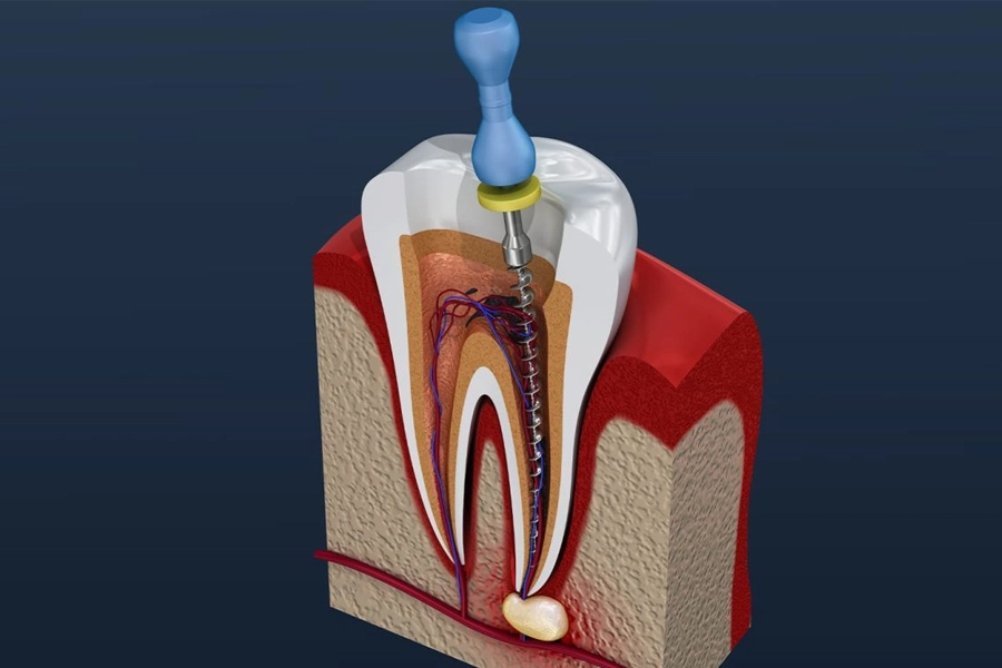 ROOT CANAL THERAPY