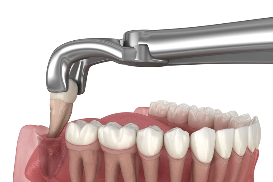 WISDOM TOOTH EXTRACTION